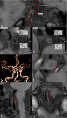 Sex Differences in Intracranial Atherosclerotic Plaques Among Patients With Ischemic Stroke